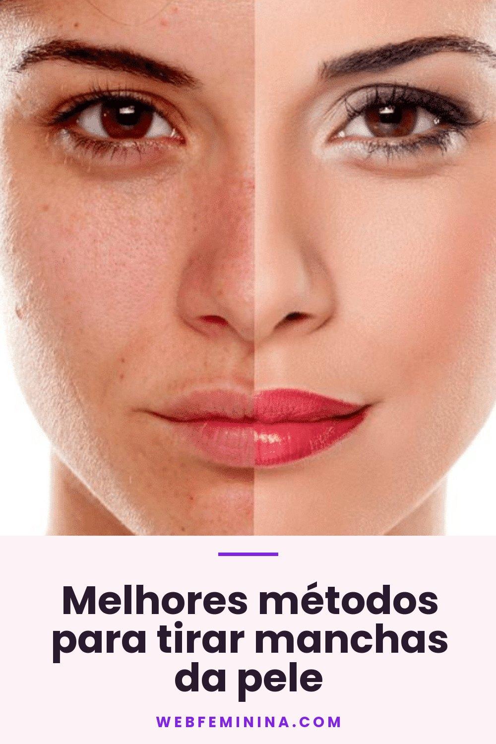 Melhores métodos para tirar manchas da pele